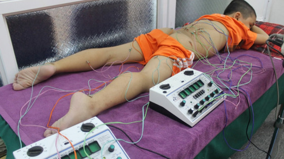 Thế mạnh của châm cứu, cấy chỉ điều trị đau nửa đầu