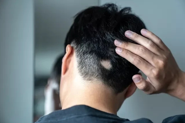Nguyên nhân, triệu chứng rụng tóc từng vùng