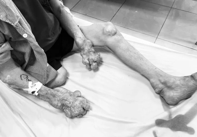 Bắc Giang: Điều trị cho 1 nam bệnh nhân bị biến chứng nhiễm trùng hạt tophi nặng nề do bệnh gout gây ra