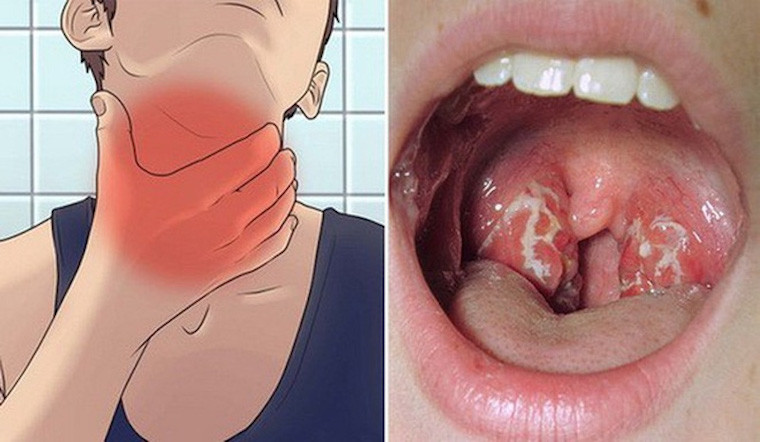 Tăng cường sức đề kháng phòng ngừa bệnh bạch hầu