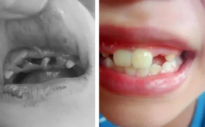 Quảng Ninh: Xử trí cho 1 trường hợp bệnh nhi bị bật răng khỏi ổ răng do tai nạn sinh hoạt