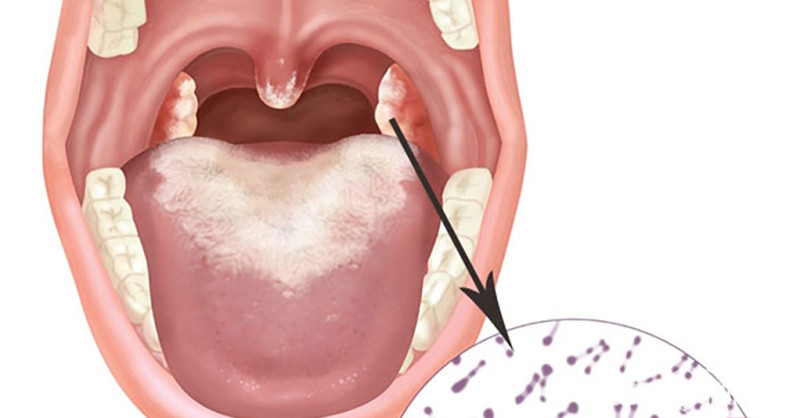Bài thuốc điều trị bệnh bạch hầu