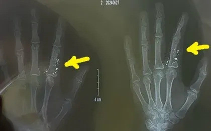 Cấp cứu 1 trường hợp suýt phải cắt bỏ 1 phần tay do nhiễm độc thuỷ ngân từ nhiệt kế vỡ