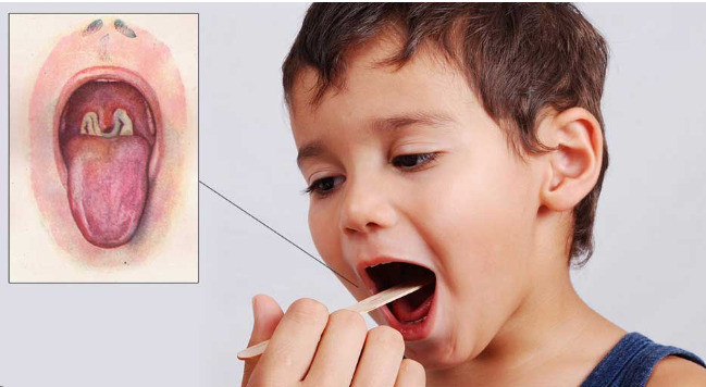 Hỏi đáp về bệnh bạch hầu