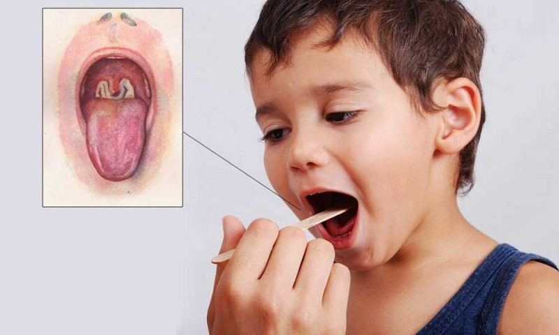 Bài thuốc chữa bệnh bạch hầu