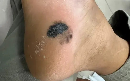 Hà Nội: Nhiều ca bệnh có gót chân màu đen và tổn thương màu đen vùng gan bàn chân nhập viện điều trị