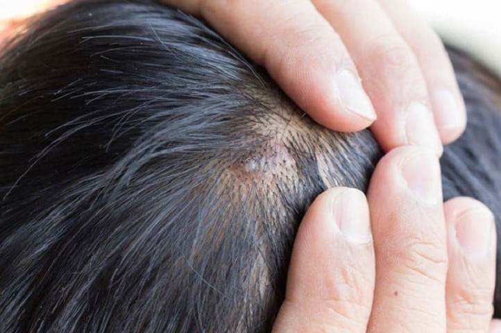 Hà Nội: Điều trị cho bệnh nhân 41 tuổi mắc ung thư tuyến bã trên nền bớt tuyến bã bẩm sinh