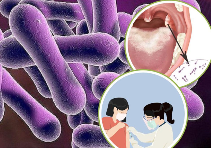 Lào Cai: Thông tin về trường hợp có biểu hiện giống bệnh bạch hầu đang điều trị tại Bệnh viện Đa khoa huyện Bảo Thắng