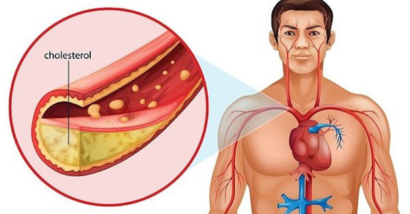5 dấu hiệu điển hình cảnh báo mức cholesterol cao
