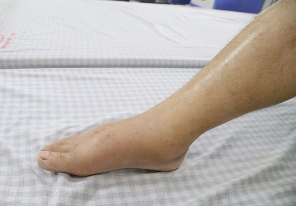 Phú Thọ: Uống thuốc nam không rõ nguồn gốc, người đàn ông bị phù nề khắp người