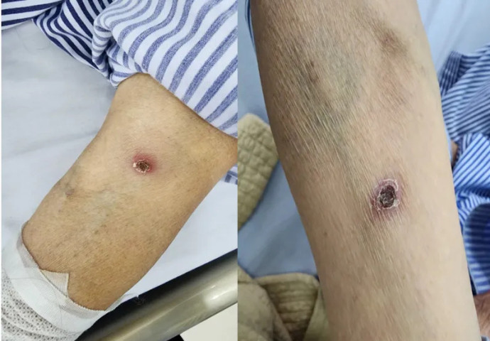 Phú Thọ: Cấp cứu bệnh nhân 68 tuổi mắc sốt mò