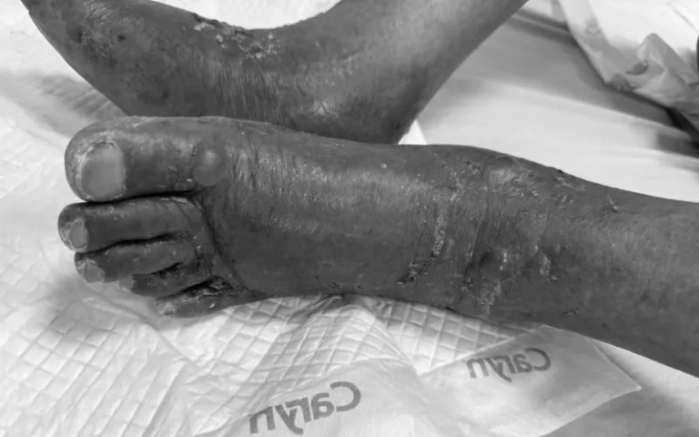 Vĩnh Long điều trị cho cụ ông 86 tuổi bị nổi bọng nước dạng pemphigus bội nhiễm
