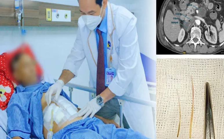 Long An: Cấp cứu bệnh nhân có 2 mảnh xương cá đâm thủng tá tràng gây sốc nhiễm trùng nặng