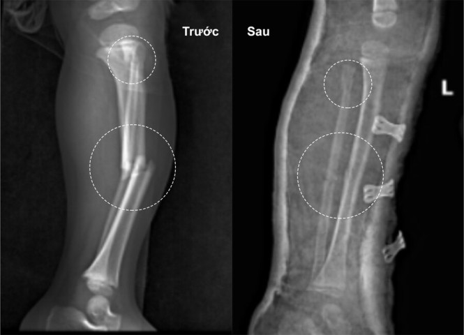 Phú Thọ: Ngã lọt chân vào khe hở cống thoát nước, bé trai 3 tuổi bị gãy hoàn toàn 2 xương cẳng chân