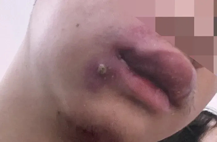 Tự nặn mụn, chàng thanh niên 19 tuổi nhiễm khuẩn huyết nghiêm trọng