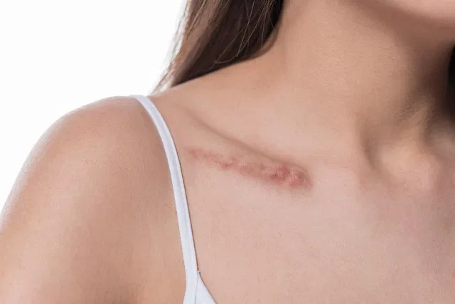 Triệu chứng, nguyên nhân và cách điều trị sẹo lồi