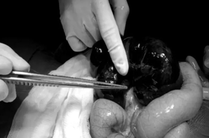 TP. Hồ Chí Minh: Bé gái sơ sinh 9 ngày tuổi bị xoắn ruột non với những triệu chứng rất khó phát hiện