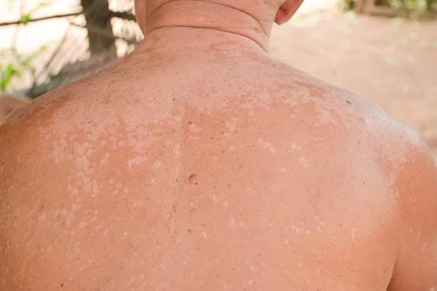 Triệu chứng và cách điều trị nấm ngoài da