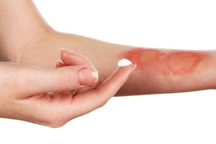 Quảng Ninh: Cảnh báo nhiều trường hợp bị bỏng do tai nạn sinh hoạt