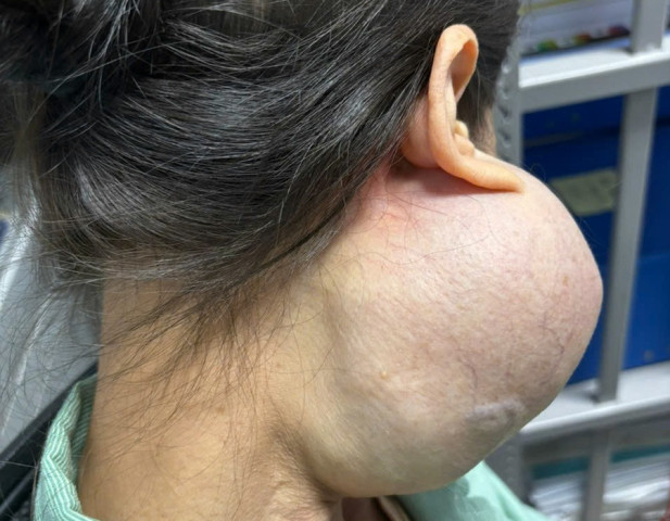 Phẫu thuật thành công cho bệnh nhân có khối u lớn trên mặt suốt 14 năm