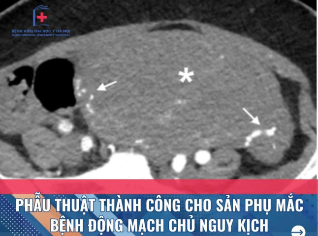 Thực hiện thành công ca phẫu thuật sản phụ mắc bệnh động mạch chủ phức tạp và nguy kịch ngay sau sinh