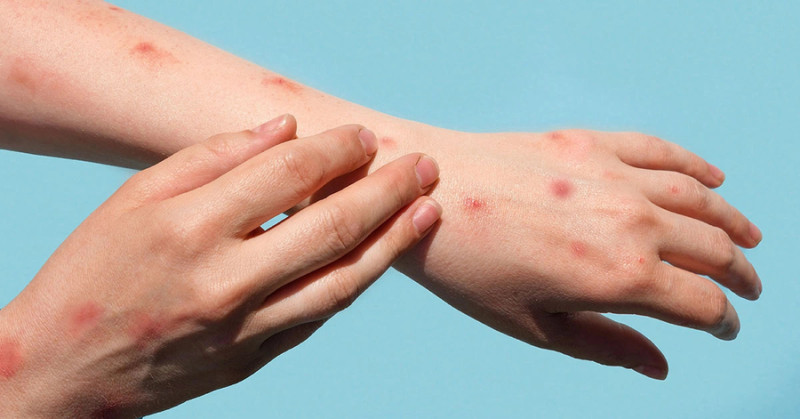 Bộ Y tế yêu cầu tăng cường giám sát cửa khẩu ngăn dịch đậu mùa khỉ