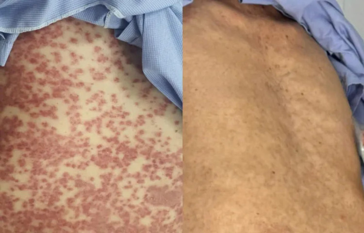 Hà Nội: Điều trị cho bệnh nhân 78 tuổi bị phát ban toàn thân do dị ứng thuốc