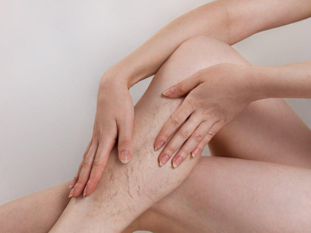 12 lời khuyên về cách tránh huyết khối