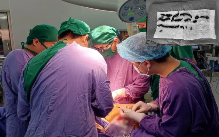 Quảng Ninh phẫu thuật lấy đoạn huyết khối dài 25 cm, cứu chân trái của cụ ông 88 tuổi khỏi nguy cơ cắt cụt vì hoại tử