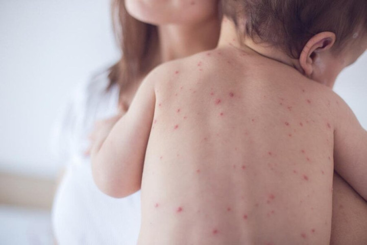 Tăng cường miễn dịch – chìa khóa phòng ngừa bệnh sởi bùng phát