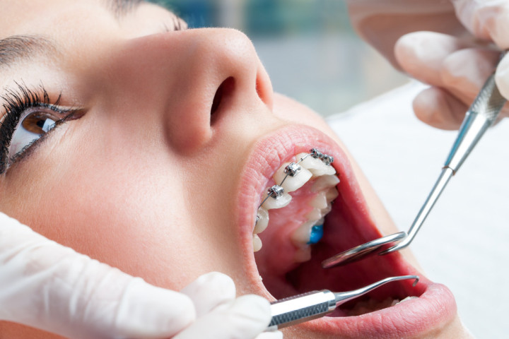 Niềng răng hỏng và những hệ lụy: Góc nhìn từ chuyên gia