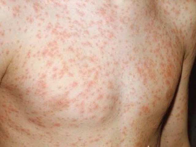 Hỏi đáp về bệnh sởi (phần 3)