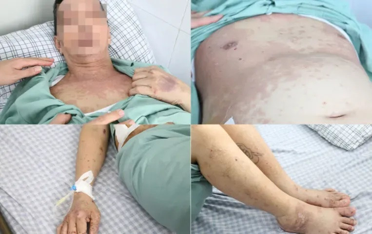 Phú Thọ: Cấp cứu người đàn ông bị dị ứng nổi mẩn toàn thân do tự ý dùng thuốc uống điều trị đau khớp