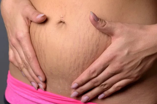 7 cách xóa vết rạn da đỏ