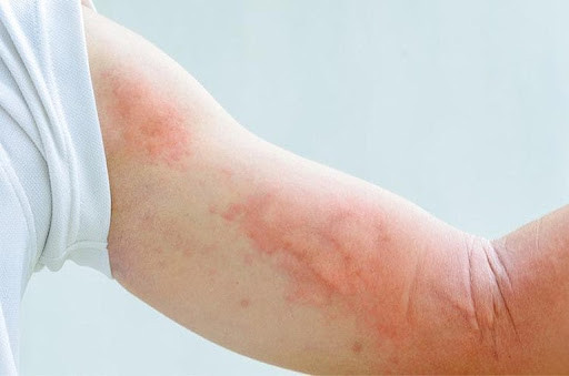 Do ăn uống không hợp vệ sinh, một người bị nhiễm ấu trùng sán dây lợn