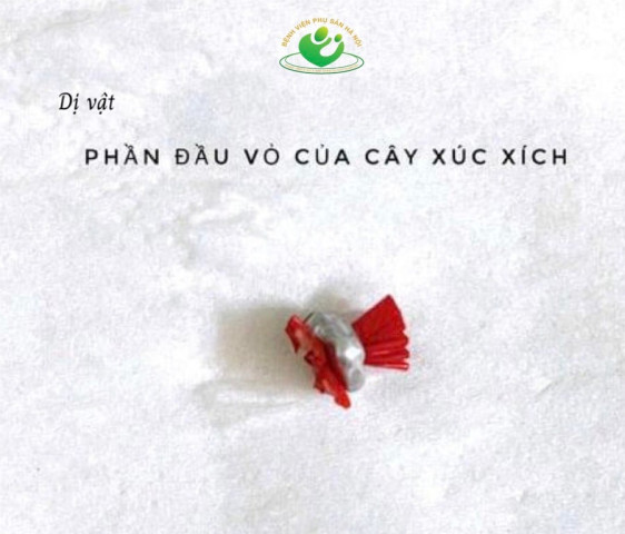 Các bác sĩ lấy dị vật "vùng kín" cho bé gái 5 tuổi thành công