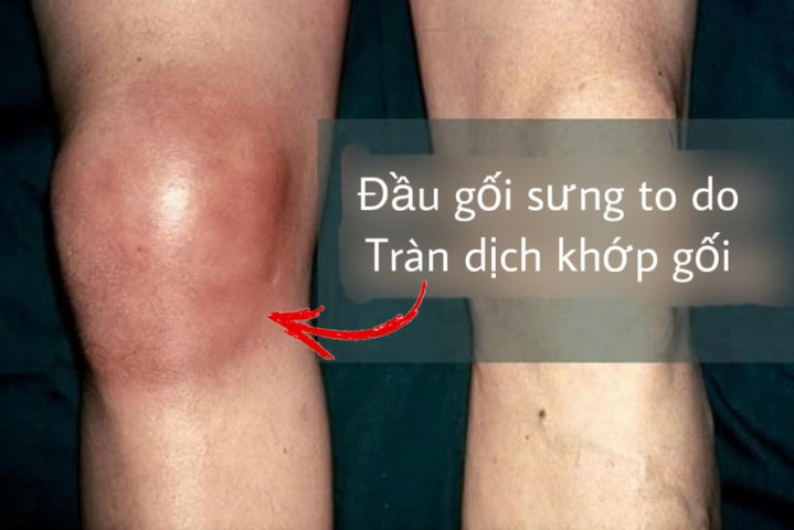 Thái Nguyên: Điều trị cho 2 trường hợp bị phản ứng sau khi tiêm huyết tương giàu tiểu cầu ở cơ sở tư nhân quảng cáo "trẻ hóa khớp gối"