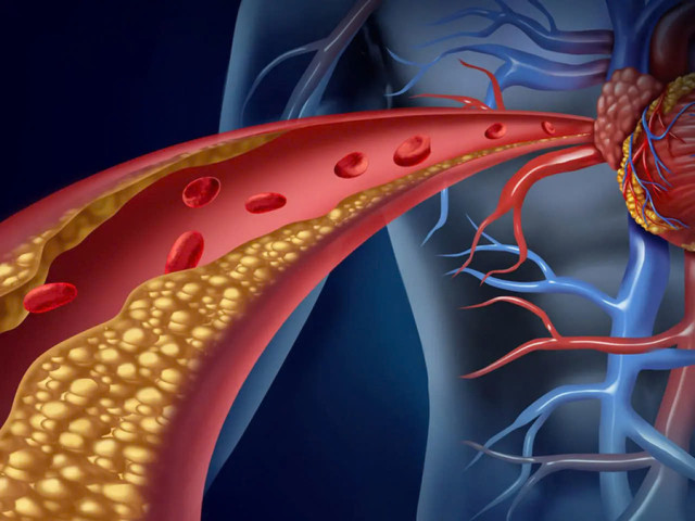 Vì sao cần giảm mức cholesterol trong cơ thể? - Một giải pháp đến từ Codoca Omega 3.6.9