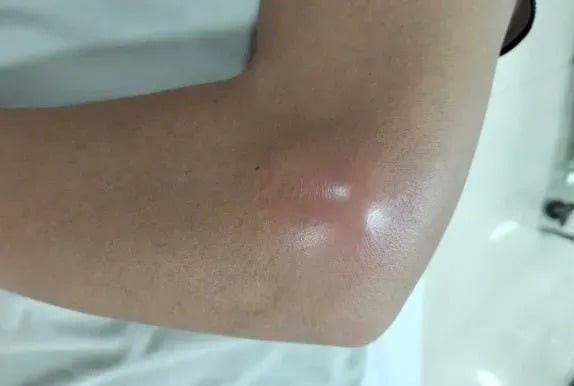 Quảng Ninh: Tiêm khớp tại cơ sở không an toàn, người bệnh bị sưng đỏ gây áp xe khuỷu tay