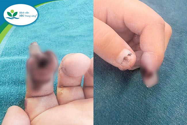 Hà Nội: Phẫu thuật nối búp ngón tay đứt rời cho bé gái 3 tuổi bị kẹp tay vào cửa