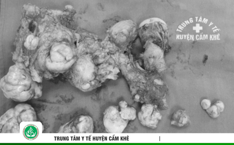 Phú Thọ: Phẫu thuật cho nữ bệnh nhân có nhiều khối u xơ tử cung lớn