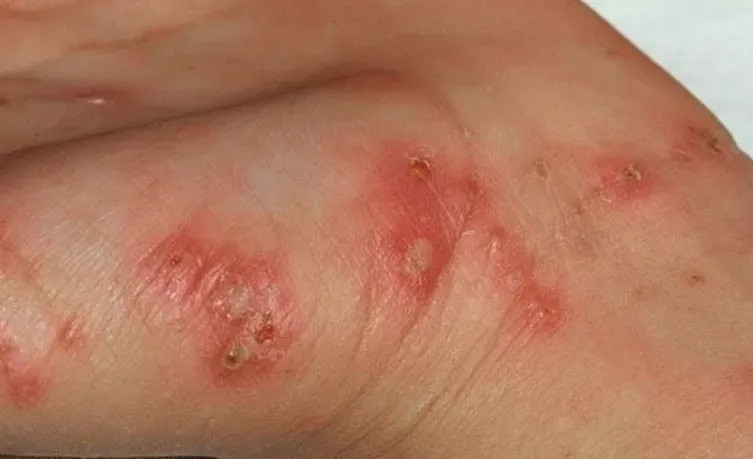 Chuyên gia khuyến cáo những cách phòng tránh bệnh ghẻ mùa mưa lũ