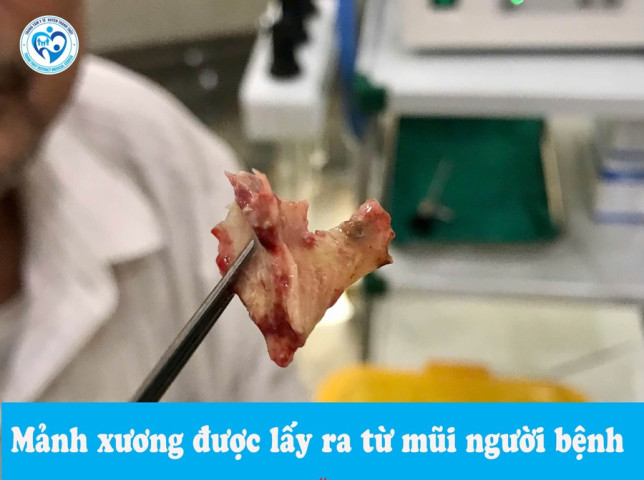Phú Thọ: Nội soi lấy ra dị vật là mảnh xương mắc trong mũi người bệnh