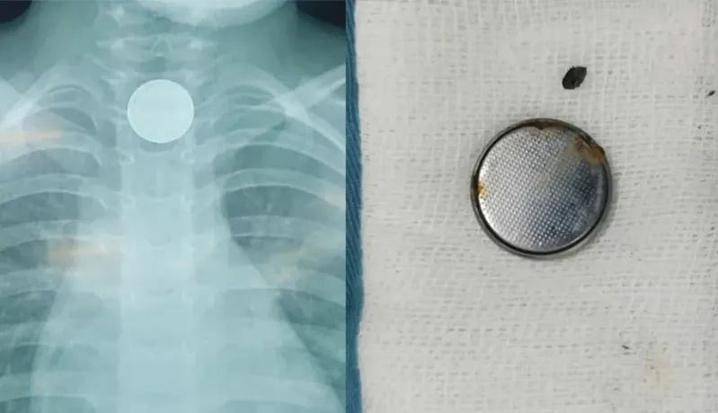 Đồng Nai: Nội soi gắp thành công viên pin hình cúc áo ra khỏi thực quản nữ bệnh nhi 4 tuổi