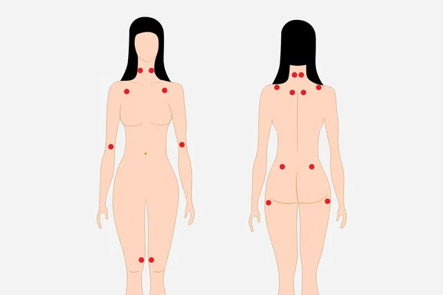 18 điểm đau cơ xơ hóa hàng đầu