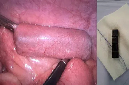 TP. Hồ Chí Minh: Nội soi lấy thành công 4 viên nam châm trong bụng bé trai 7 tuổi