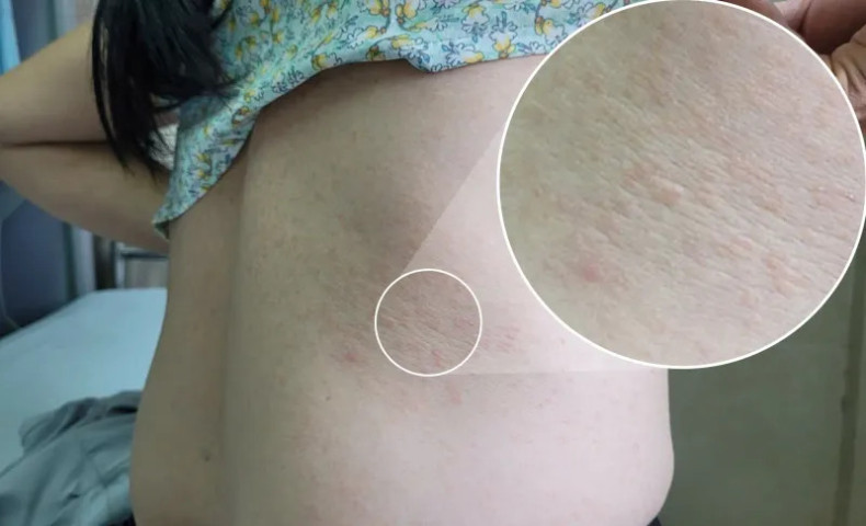Phú Thọ: Điều trị cho bệnh nhân mắc giun đũa chó mèo