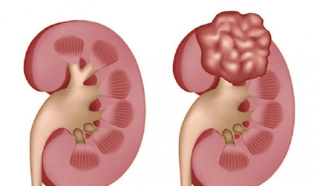 Những triệu chứng của bệnh thận đa nang