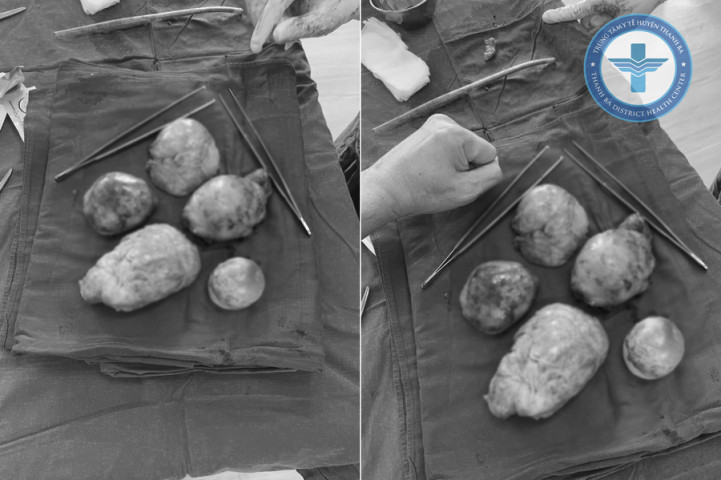 Phú Thọ: Thực hiện thành công ca phẫu thuật cắt bỏ khối u xơ tử cung và u nang buồng trứng phải kích thước lớn cho bệnh nhân