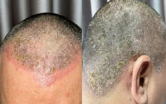 Quảng Ninh: Điều trị cho 1 người bệnh bị dị ứng do thuốc nhuộm tóc